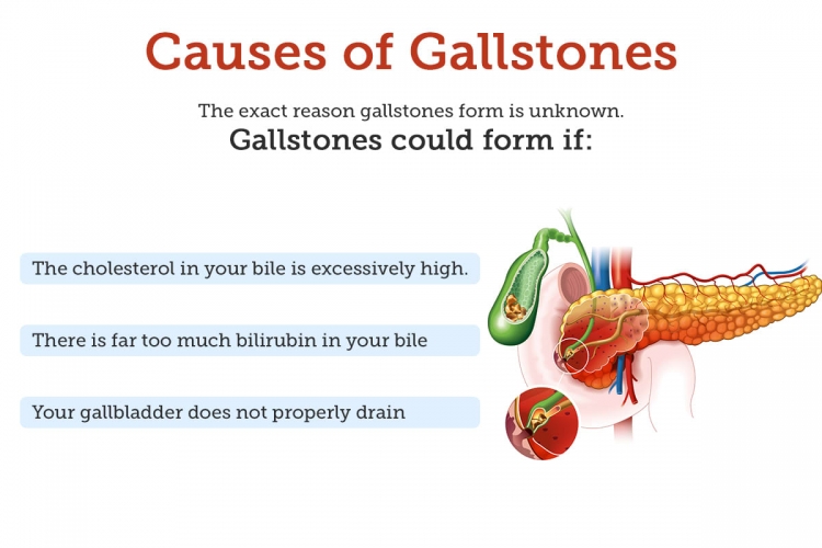 Gallbladder Stones